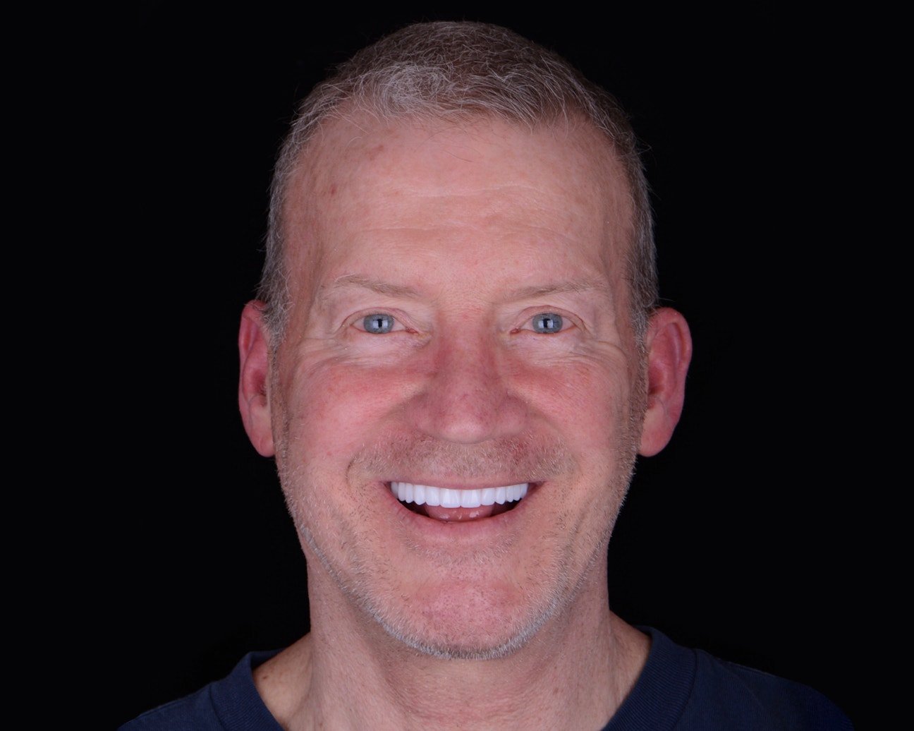 joe-after-dental-implants-clearchoice-woburn
